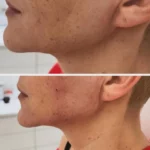 zabieg korekta żuchwy w Lublinie - Dr Siembida