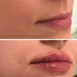 zabieg modelowanie ust w Lublinie - Dr Siembida