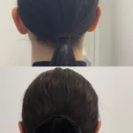 Chirurgiczne korekta odstających uszu w Lublinie